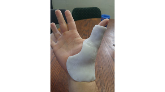 Hand brace to stabilize thumb made with InstaMorph moldable plastic.